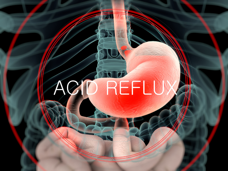 What is acid reflux?