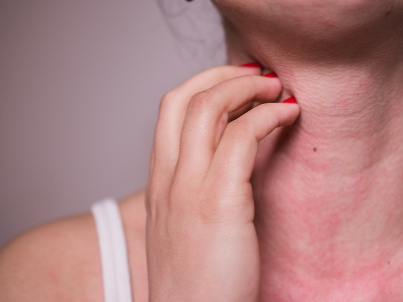 Preventing severe allergic reactions