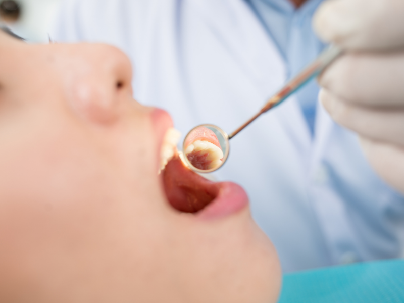 What are the symptoms of oral cancer? | Oncologists in Mangalore