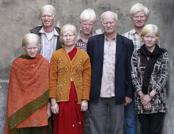 Albinism is caused by inheriting mutations in specific genes that disrupt the production, transportation, or storage of melanin in the body